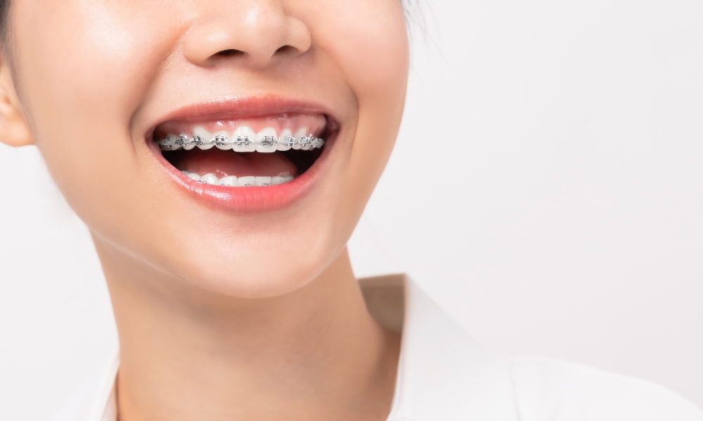 Aparat ortodontyczny - zanim założysz, odwiedź fizjoterapeutę!